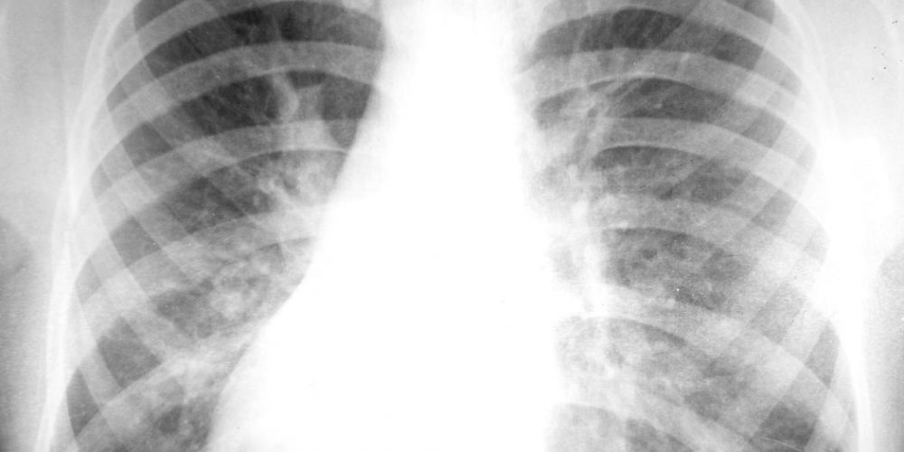 special-topics-in-TB-management